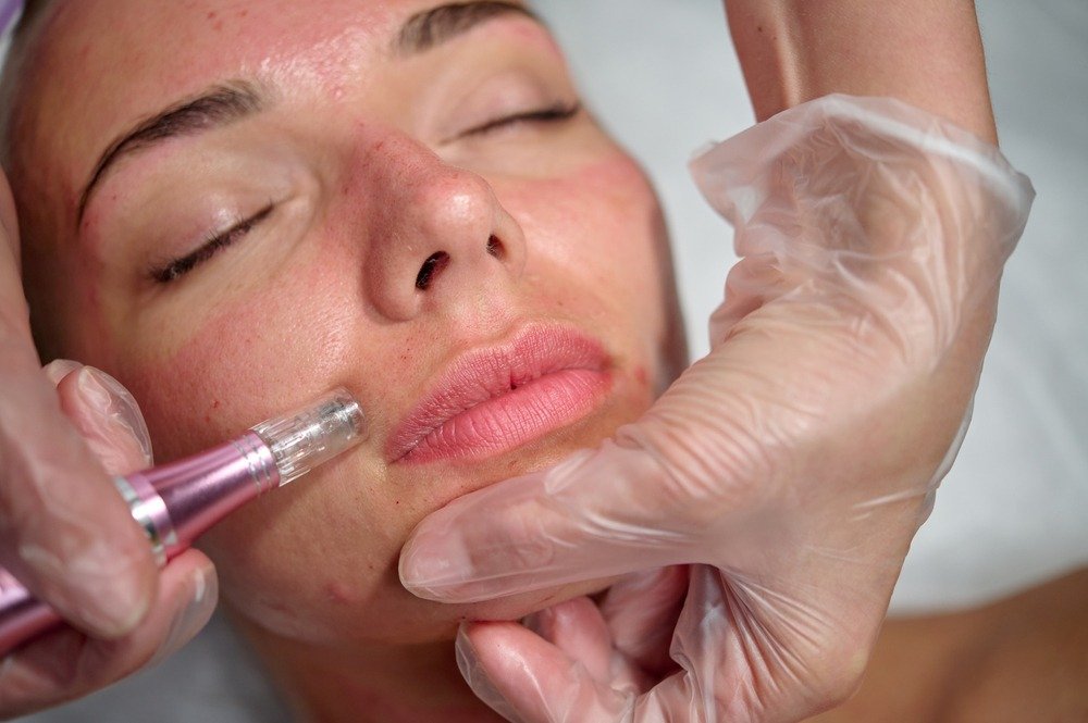 Microneedling treatment in progress